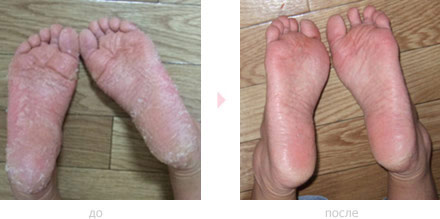 кожа ступней до и после применения носков baby foot