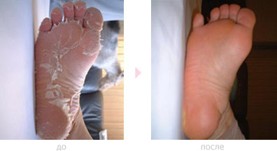 ухоженные ноги с носками Baby Foot