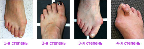 шишки у больших пальцев ног, выступающая косточка у большого пальца ноги