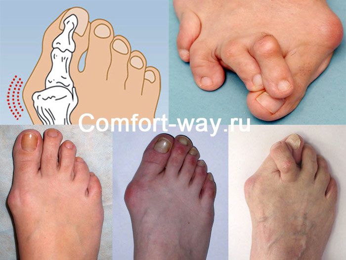 лечение косточек на больших пальцах ног